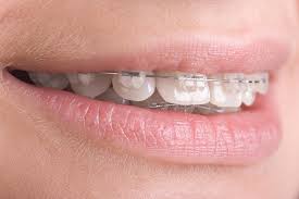 Điều trị niềng răng thẩm mỹ như thế nào ?