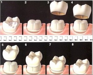 Phương pháp trồng răng giả cố định Trong-rang-co-dinh-1