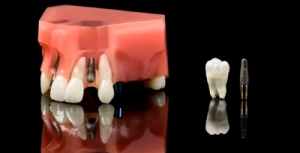 Phương pháp trồng răng giả cố định Trong-rang-co-dinh